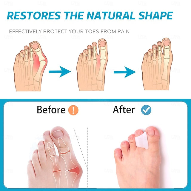 6 Pack Toe Spacers and Separators for Bunion, Curled and Overlapping Toe Alignment for Men and Women